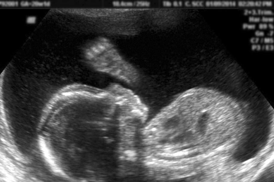 Ultrasound Image of baby