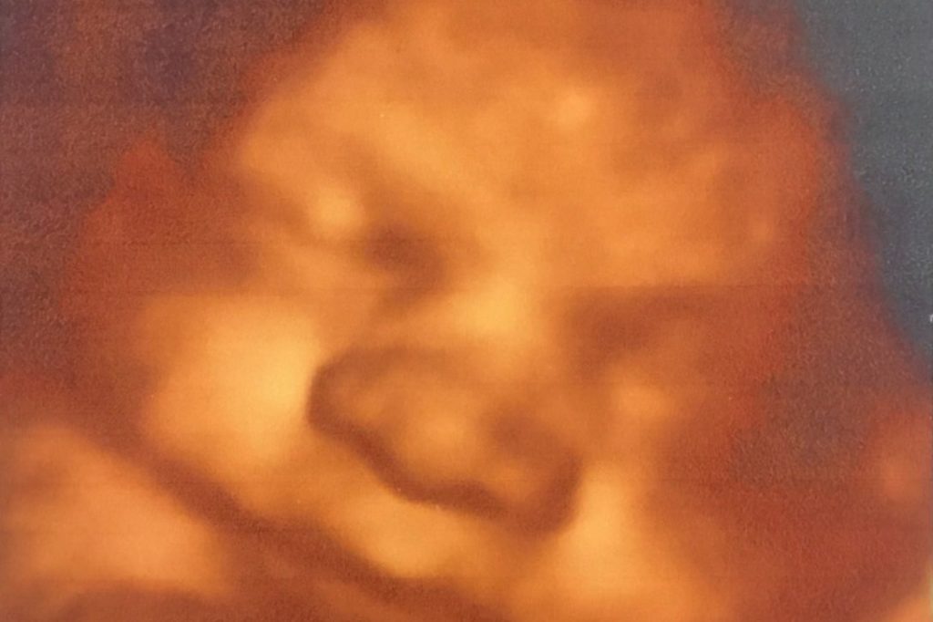 Ultrasound image of a baby's face